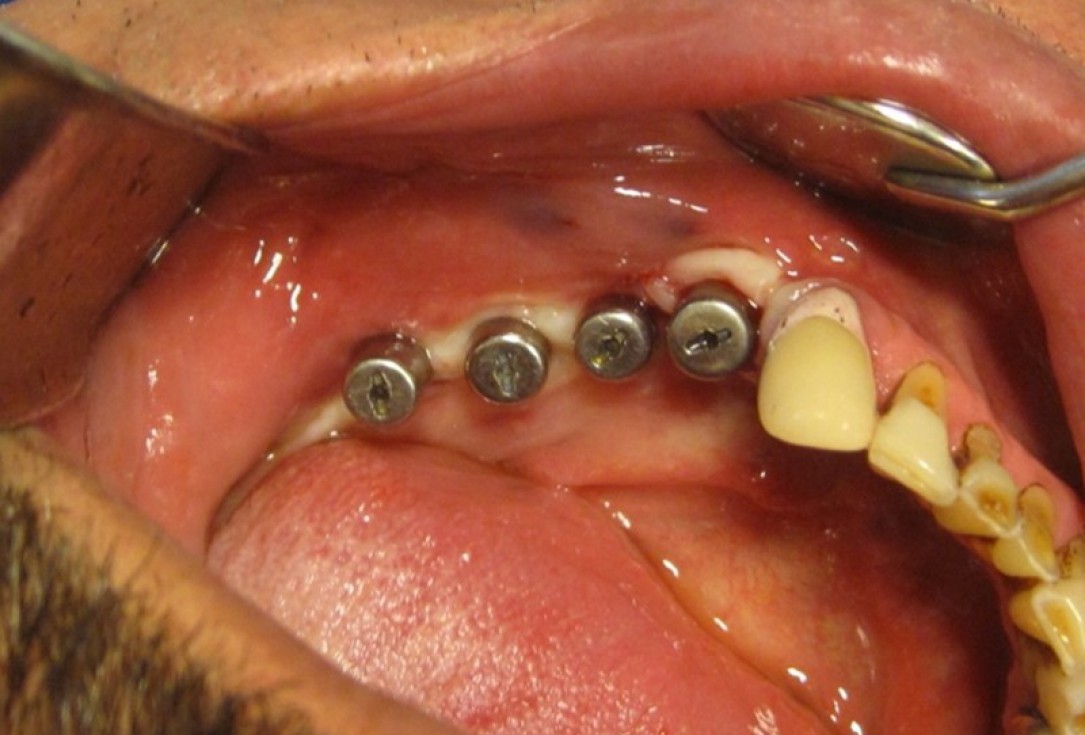 botiss cerabone for ridge splitting and augmentation of an atrophic alveolar ridge - Clinical case by Dr. V. Moshirabadi