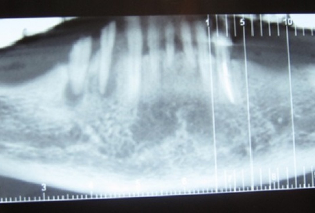 botiss cerabone for ridge splitting and augmentation of an atrophic alveolar ridge - Clinical case by Dr. V. Moshirabadi