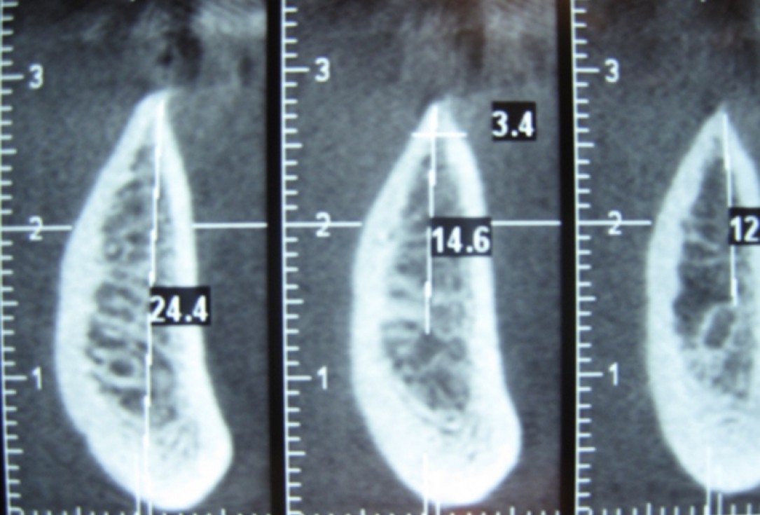 botiss cerabone for ridge splitting and augmentation of an atrophic alveolar ridge - Clinical case by Dr. V. Moshirabadi