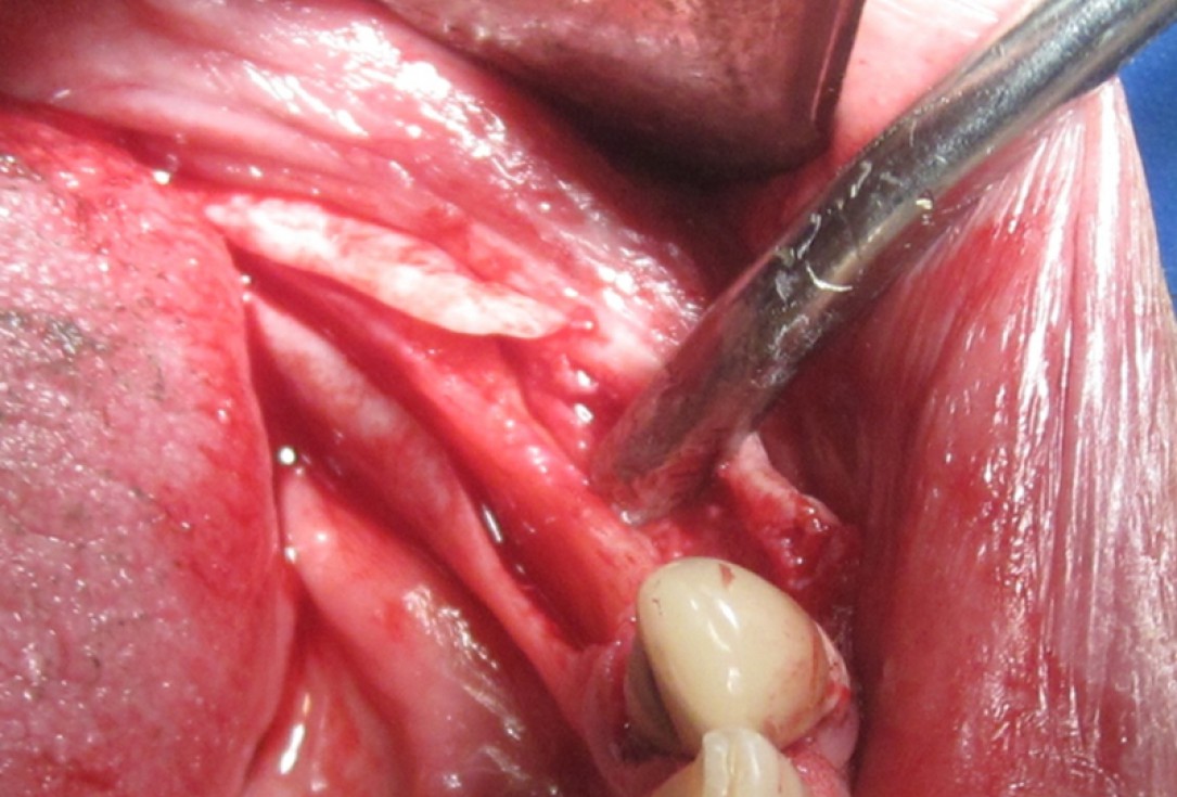 botiss cerabone for ridge splitting and augmentation of an atrophic alveolar ridge - Clinical case by Dr. V. Moshirabadi