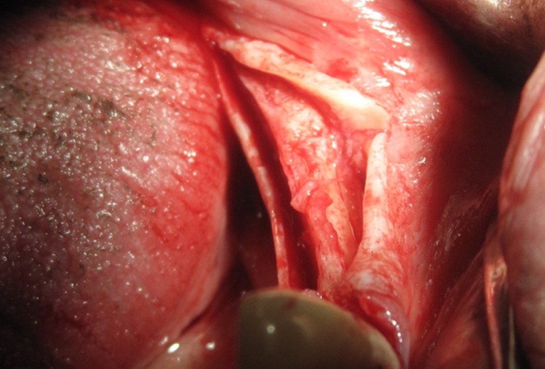 botiss cerabone for ridge splitting and augmentation of an atrophic alveolar ridge - Clinical case by Dr. V. Moshirabadi