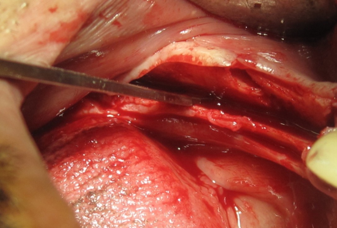 botiss cerabone for ridge splitting and augmentation of an atrophic alveolar ridge - Clinical case by Dr. V. Moshirabadi