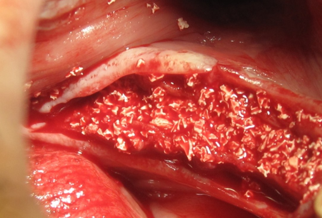 botiss cerabone for ridge splitting and augmentation of an atrophic alveolar ridge - Clinical case by Dr. V. Moshirabadi