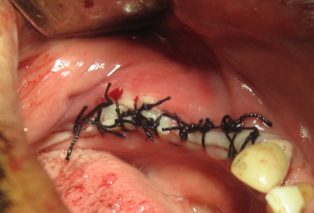 botiss cerabone for ridge splitting and augmentation of an atrophic alveolar ridge - Clinical case by Dr. V. Moshirabadi