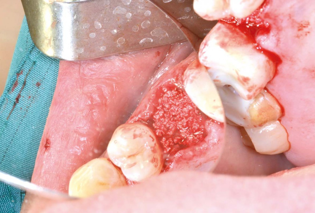 Socket preservation with cerabone® - Dr. P. Kämmerer