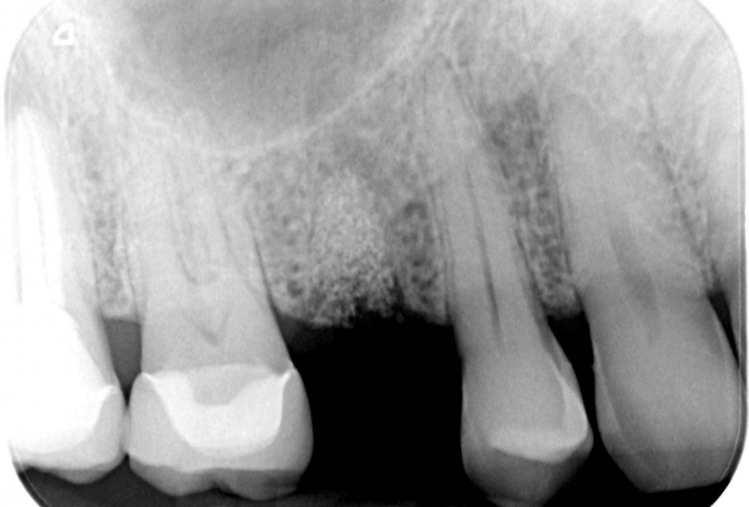 Socket preservation with cerabone® - Dr. P. Kämmerer