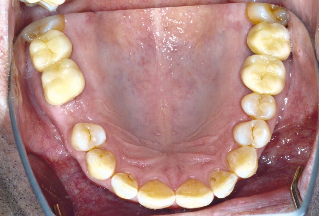 Socket preservation with cerabone® - Dr. P. Kämmerer