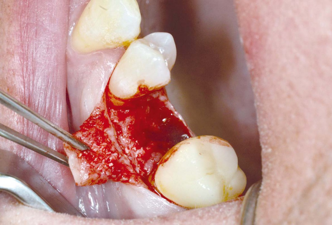 Socket preservation with cerabone® - Dr. P. Kämmerer