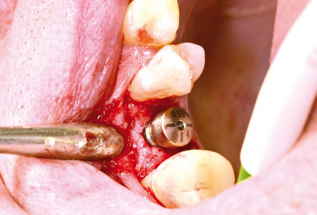 Socket preservation with cerabone® - Dr. P. Kämmerer