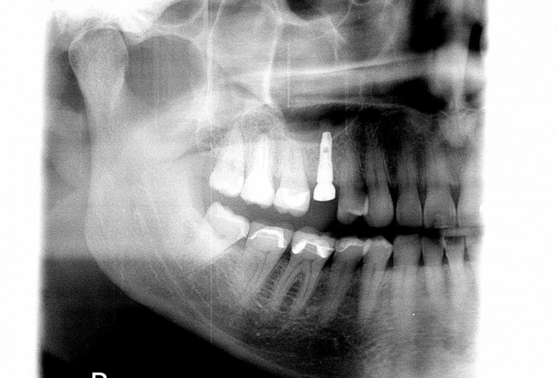 Socket preservation with cerabone® - Dr. P. Kämmerer