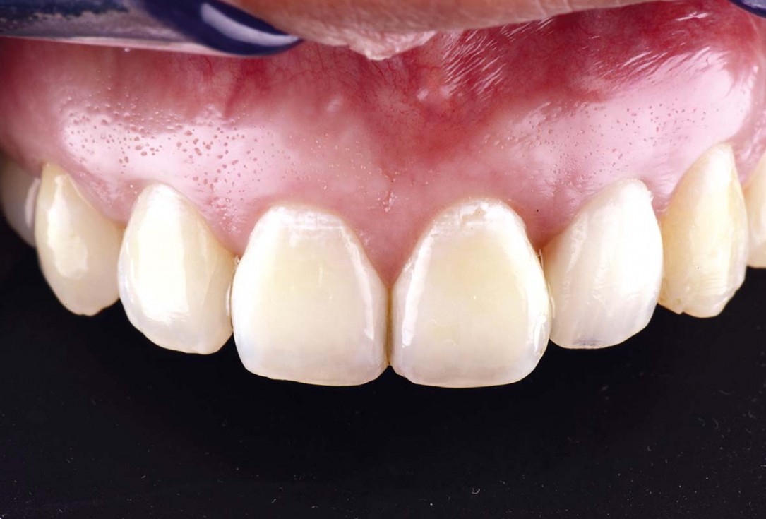 Horizontal ridge augmentation using cerabone® block, permamem® and Jason® membrane - Dr. P. Lázaro
