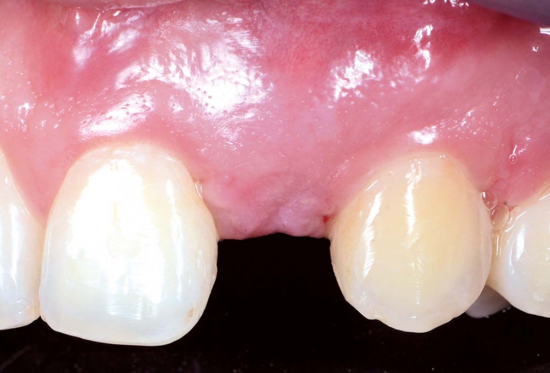 Horizontal ridge augmentation using cerabone® block, permamem® and Jason® membrane - Dr. P. Lázaro