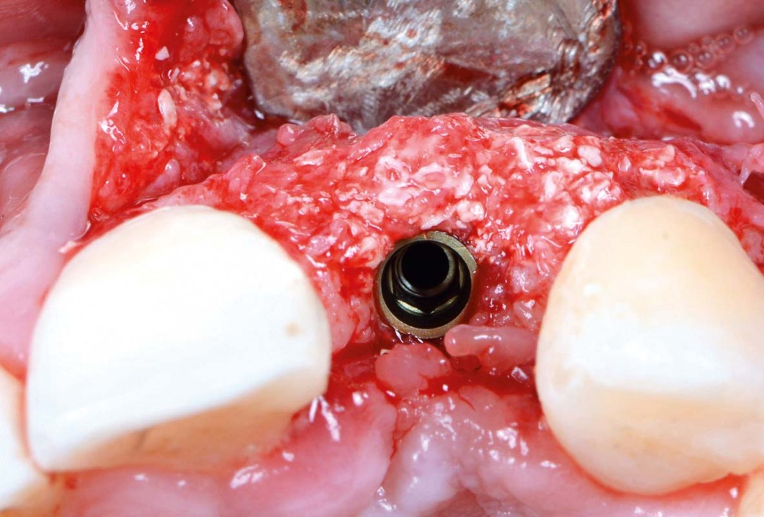 Horizontal ridge augmentation using cerabone® block, permamem® and Jason® membrane - Dr. P. Lázaro