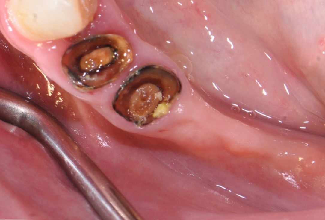 Ridge augmentation with maxgraft® bonebuilder - Dr. V. Kalenchuk