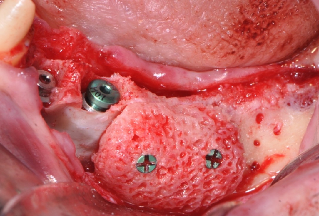 Ridge augmentation with maxgraft® bonebuilder - Dr. V. Kalenchuk