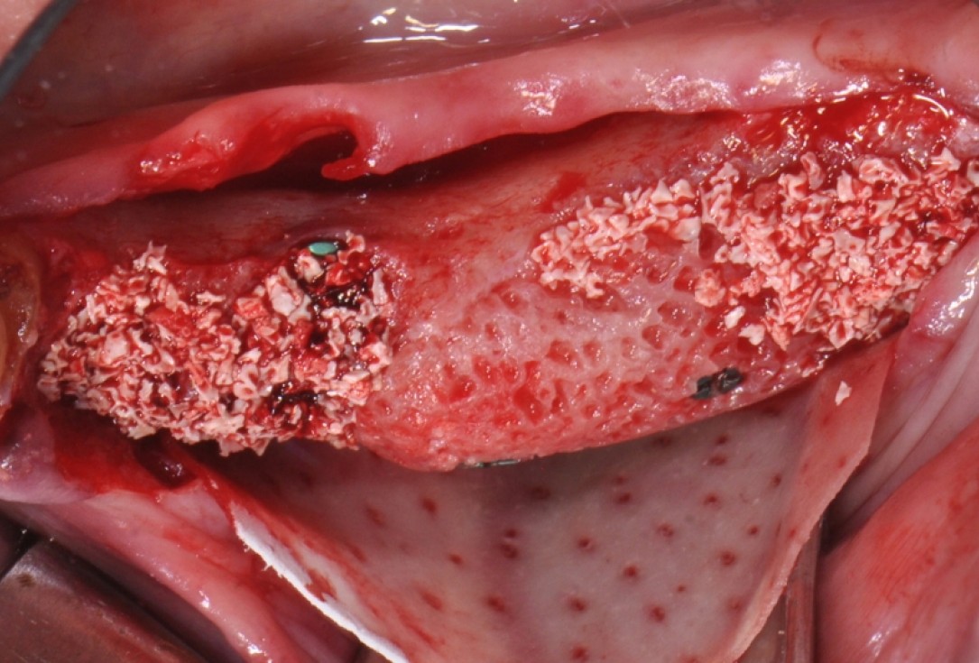 Ridge augmentation with maxgraft® bonebuilder - Dr. V. Kalenchuk