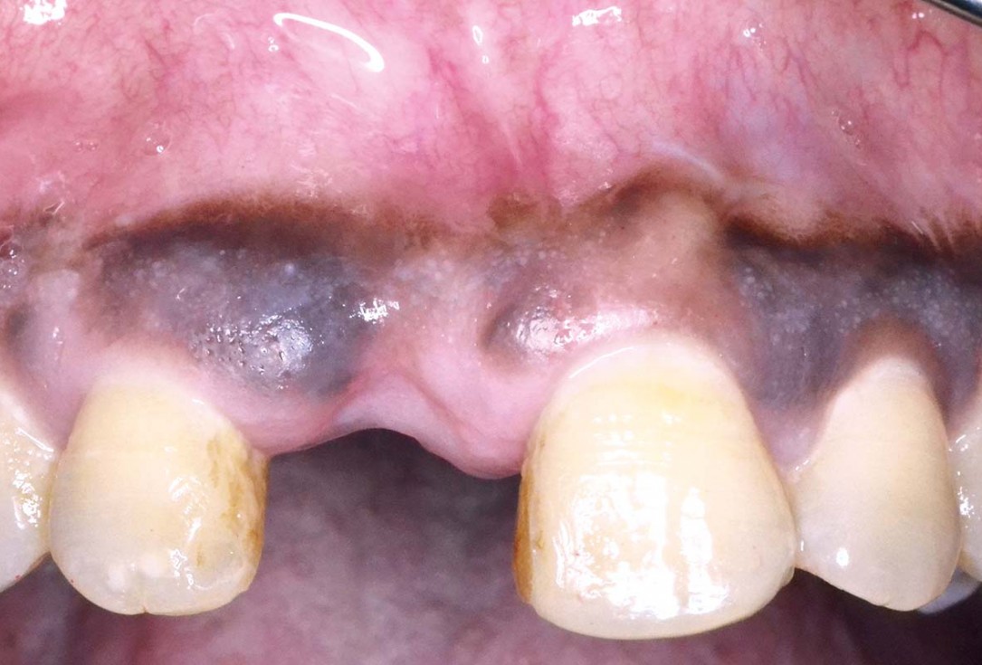 Treatment of a fenestration defect using maxgraft® and permamem® - Dr. Y. Kassem