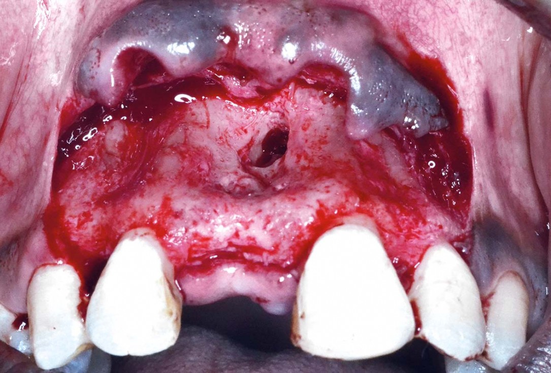 Treatment of a fenestration defect using maxgraft® and permamem® - Dr. Y. Kassem