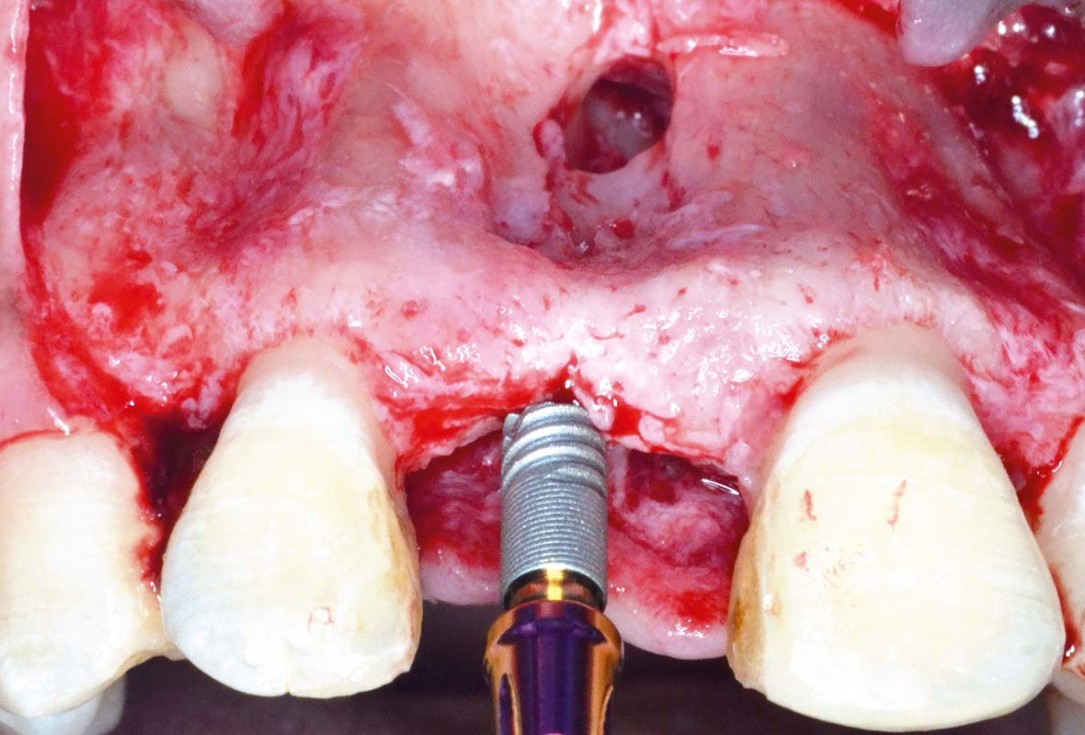Treatment of a fenestration defect using maxgraft® and permamem® - Dr. Y. Kassem