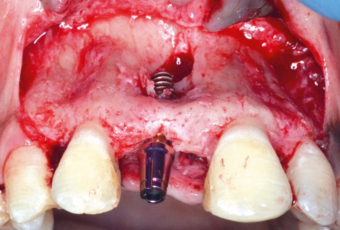 Treatment of a fenestration defect using maxgraft® and permamem® - Dr. Y. Kassem