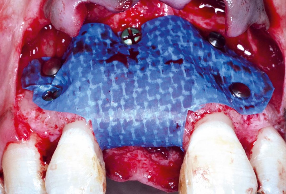 Treatment of a fenestration defect using maxgraft® and permamem® - Dr. Y. Kassem