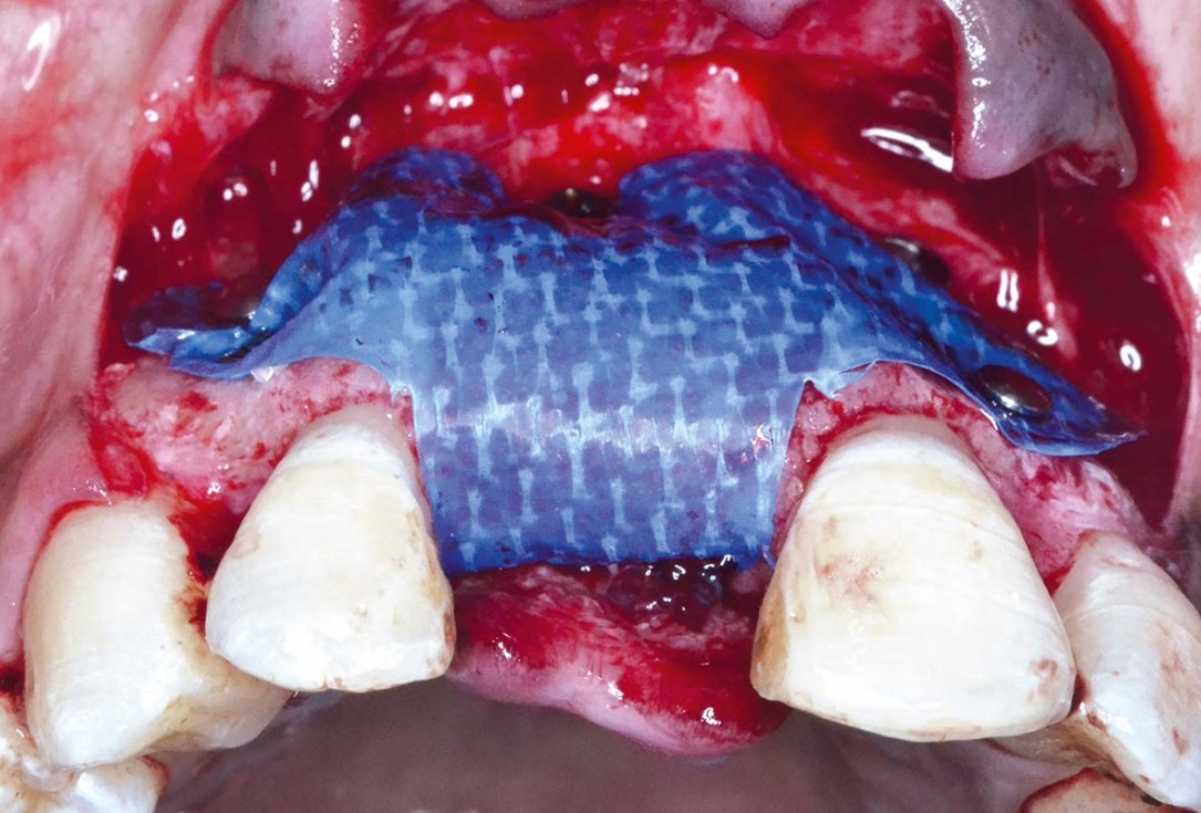 Treatment of a fenestration defect using maxgraft® and permamem® - Dr. Y. Kassem