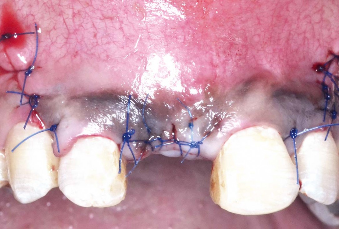 Treatment of a fenestration defect using maxgraft® and permamem® - Dr. Y. Kassem