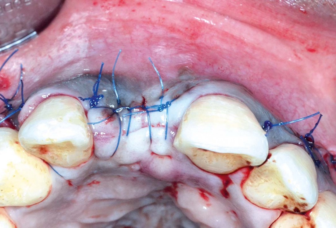 Treatment of a fenestration defect using maxgraft® and permamem® - Dr. Y. Kassem