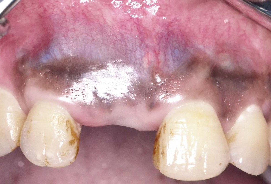 Treatment of a fenestration defect using maxgraft® and permamem® - Dr. Y. Kassem