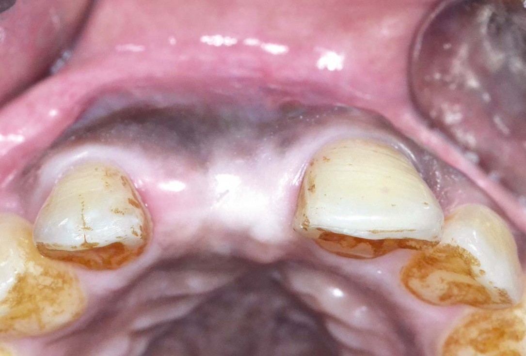 Treatment of a fenestration defect using maxgraft® and permamem® - Dr. Y. Kassem