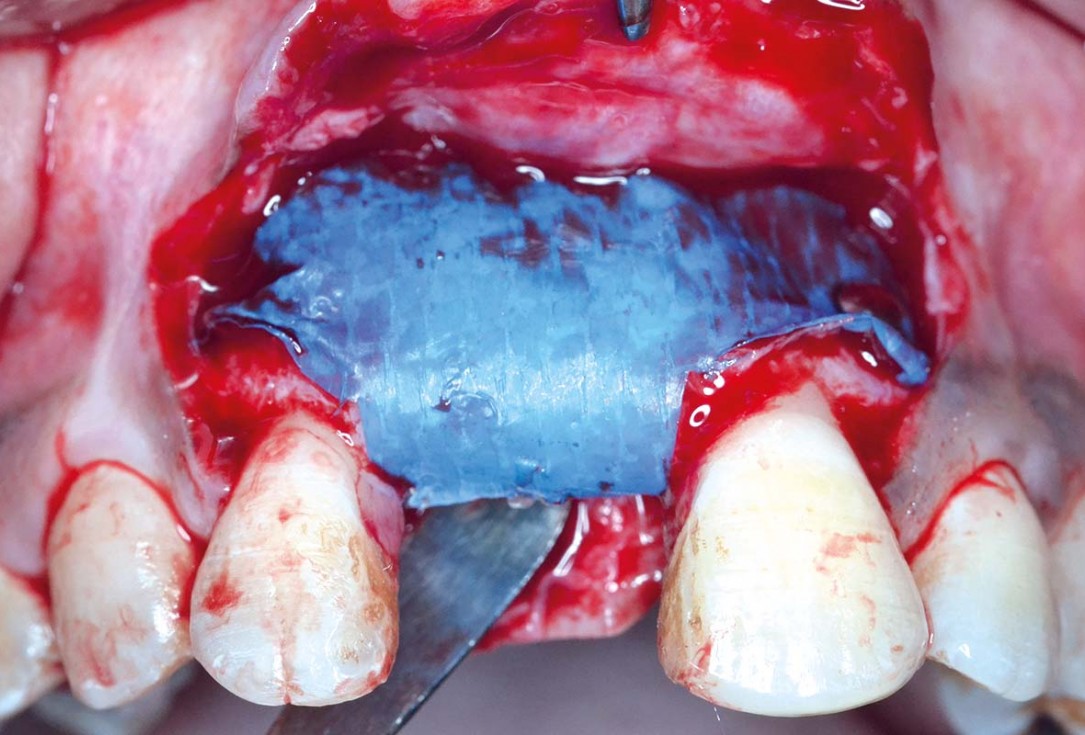 Treatment of a fenestration defect using maxgraft® and permamem® - Dr. Y. Kassem