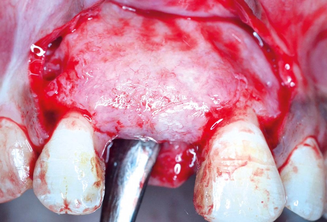 Treatment of a fenestration defect using maxgraft® and permamem® - Dr. Y. Kassem