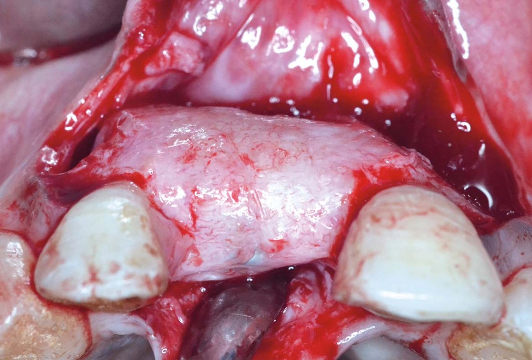 Treatment of a fenestration defect using maxgraft® and permamem® - Dr. Y. Kassem