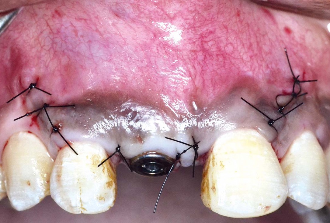 Treatment of a fenestration defect using maxgraft® and permamem® - Dr. Y. Kassem