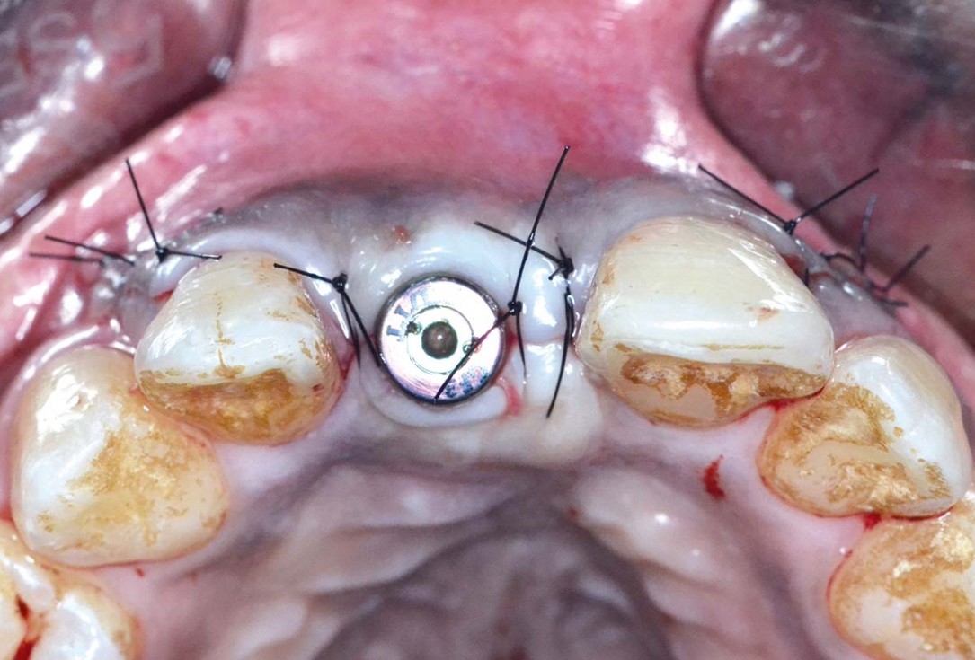 Treatment of a fenestration defect using maxgraft® and permamem® - Dr. Y. Kassem