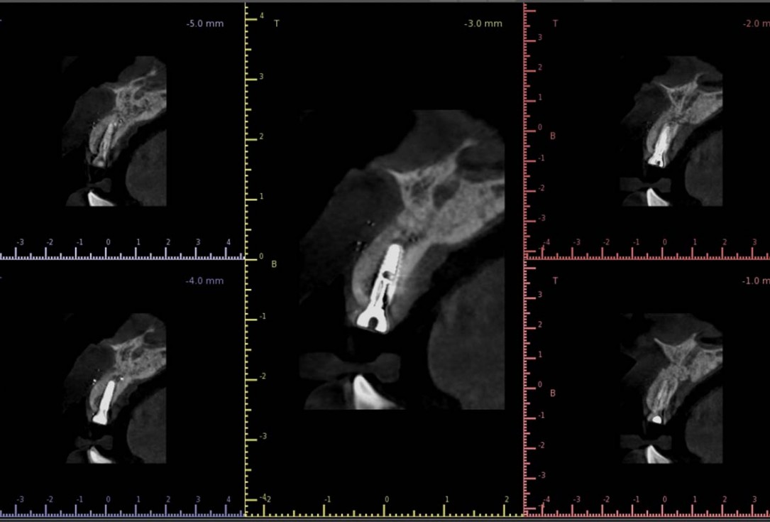 Treatment of a fenestration defect using maxgraft® and permamem® - Dr. Y. Kassem