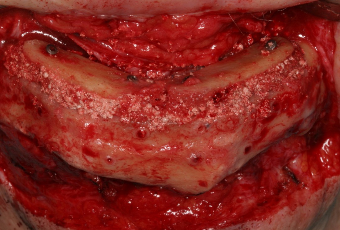 Block augmentation with maxresorb®, collprotect® membrane & autologous bone blocks - Prof. Dr. Dr. D. Rothamel