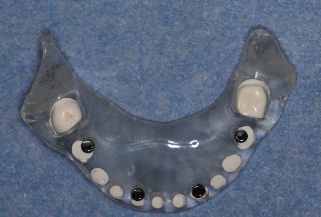 Block augmentation with maxresorb®, collprotect® membrane & autologous bone blocks - Prof. Dr. Dr. D. Rothamel