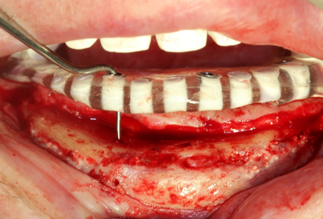 Block augmentation with maxresorb®, collprotect® membrane & autologous bone blocks - Prof. Dr. Dr. D. Rothamel