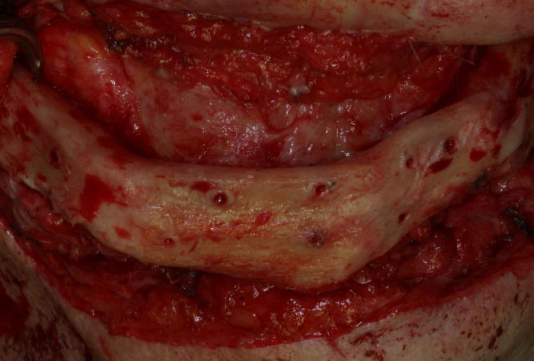 Block augmentation with maxresorb®, collprotect® membrane & autologous bone blocks - Prof. Dr. Dr. D. Rothamel