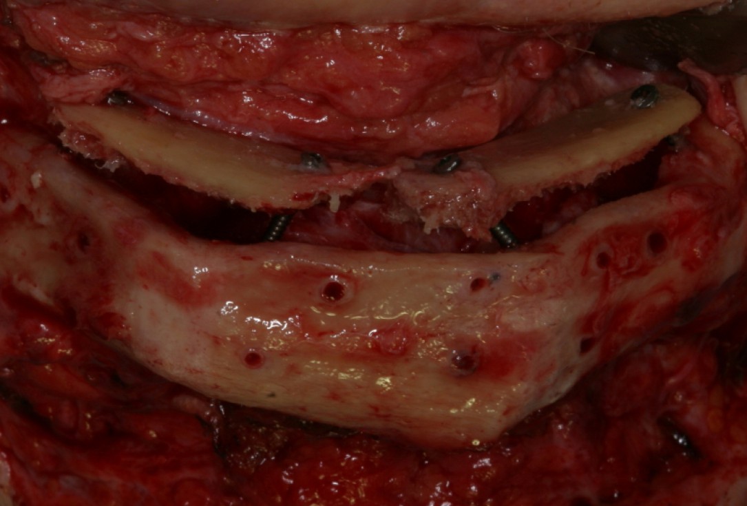 Block augmentation with maxresorb®, collprotect® membrane & autologous bone blocks - Prof. Dr. Dr. D. Rothamel