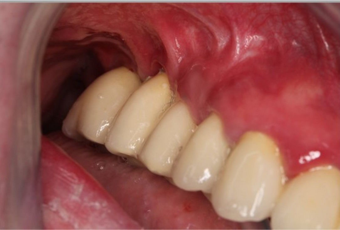 Augmentation of the maxillary attached gingiva-Stricker