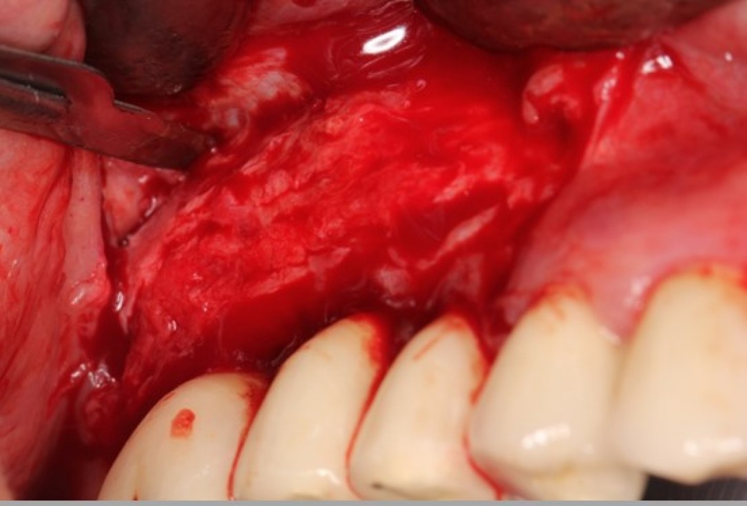 Augmentation of the maxillary attached gingiva-Stricker