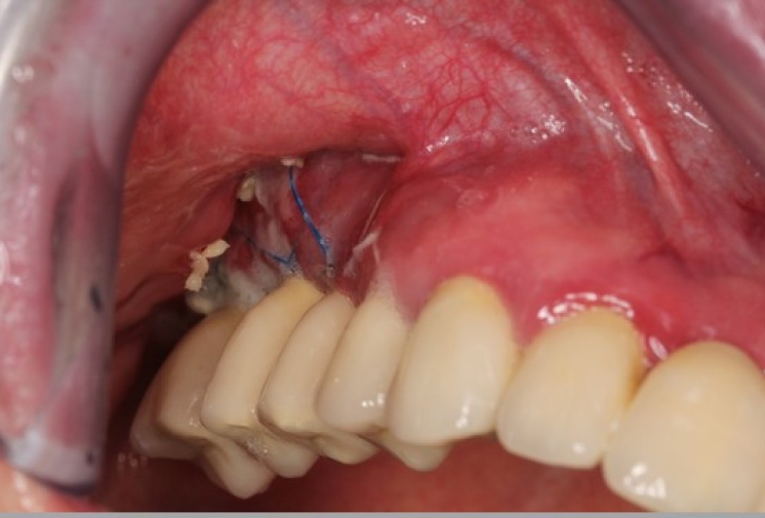 Augmenation of the maxillary attached gingiva-Stricker 