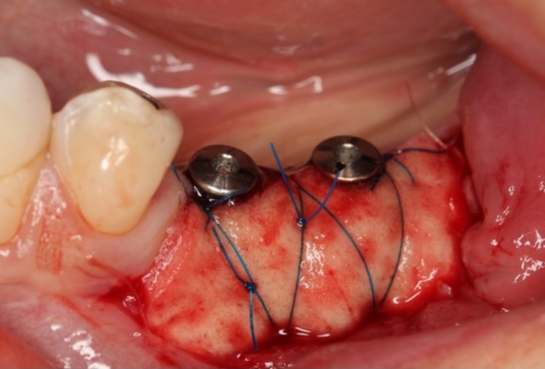 Augmentation of the mandibular attached gingiva- Stricker