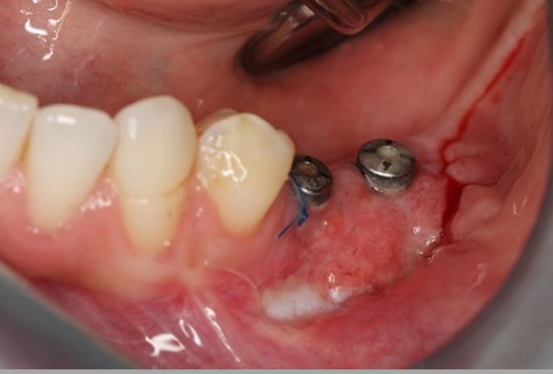 Augmentation of the mandibular attached gingiva- Stricker