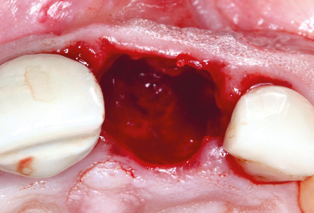 Socket augmentation using mucoderm®, maxgraft® and Straumann® Emdogain® - Dr. A. Puišys
