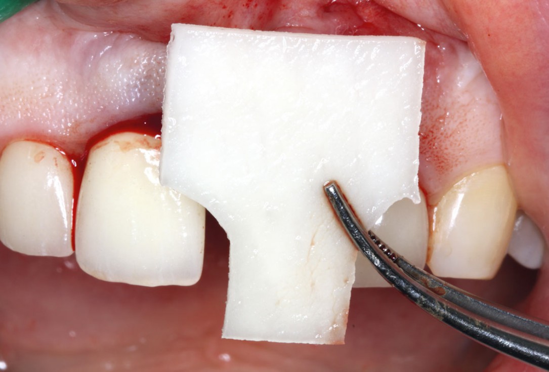 Socket augmentation using mucoderm®, maxgraft® and Straumann® Emdogain® - Dr. A. Puišys