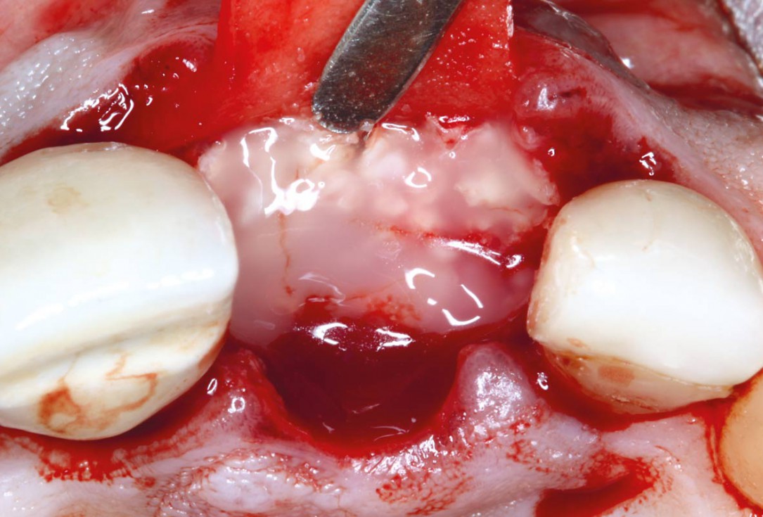 Socket augmentation using mucoderm®, maxgraft® and Straumann® Emdogain® - Dr. A. Puišys