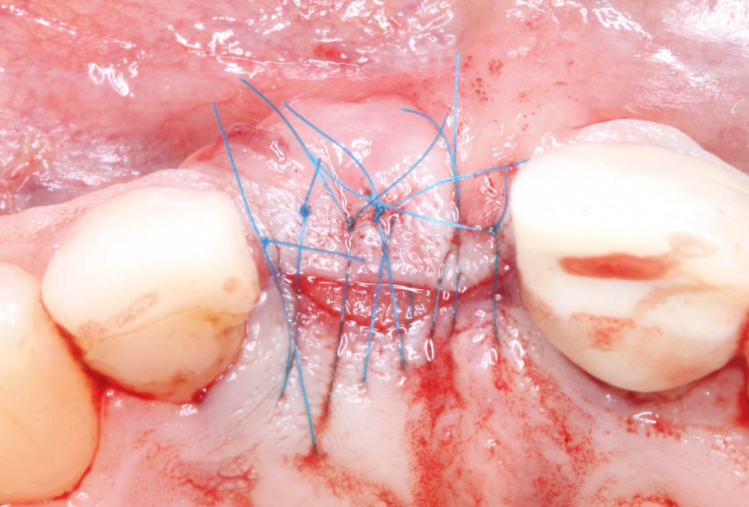 Socket augmentation using mucoderm®, maxgraft® and Straumann® Emdogain® - Dr. A. Puišys